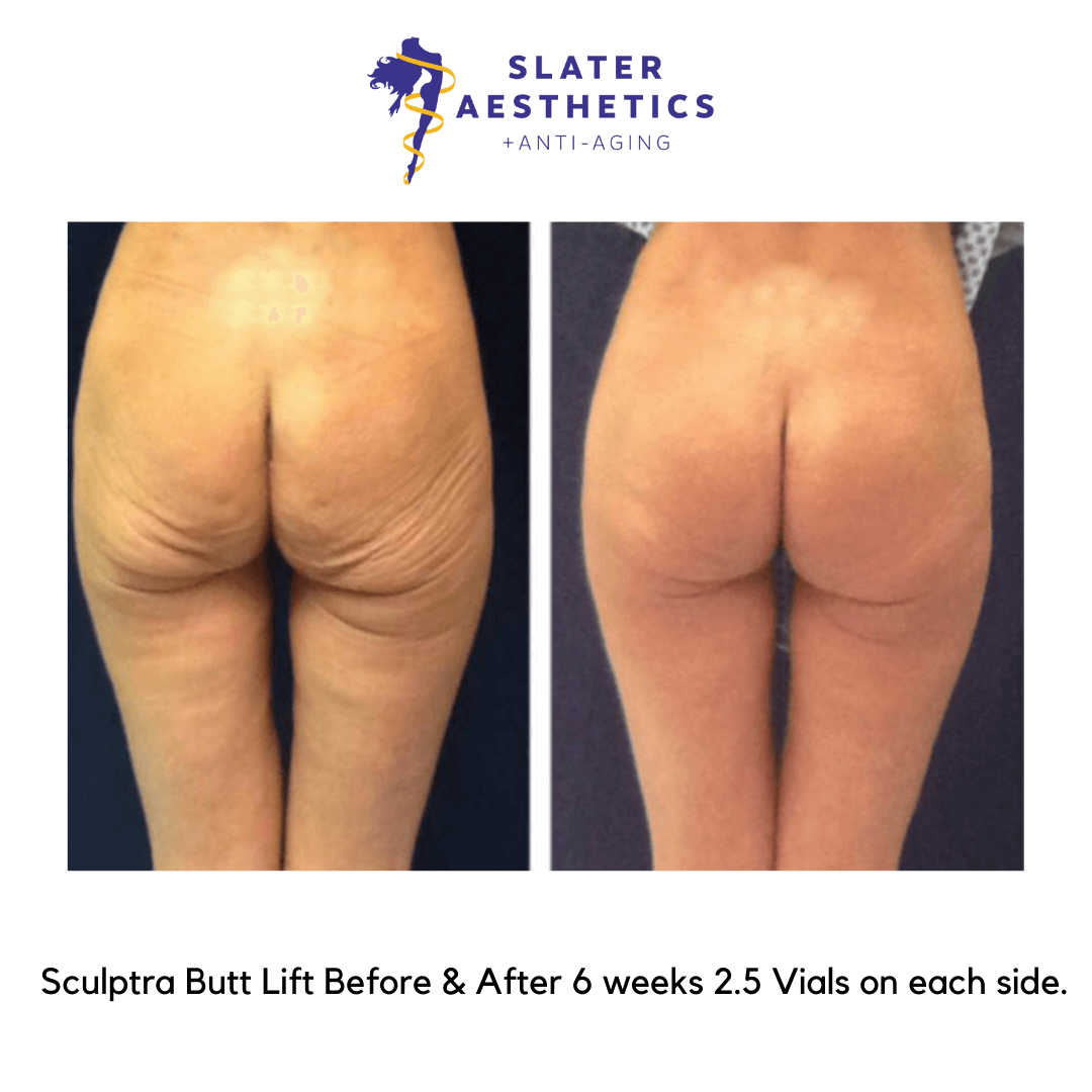 Brazilian Butt Lift Sculptra Butt Lift Results Dr Monte Slater