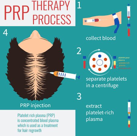 Platelet Rich Plasma Treatments for Hair Loss
