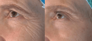 Vivace Micro-Needling RF Before and After Pictures 