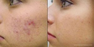 Vivace Micro-Needling RF for active Acne and to reduce scars