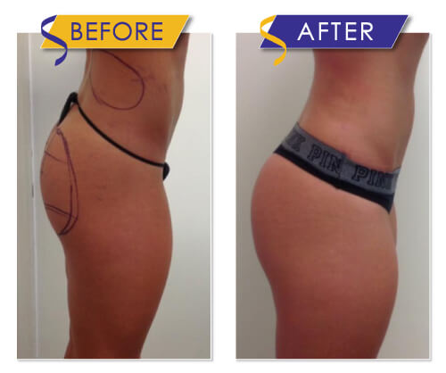 Sculptra Butt Lift