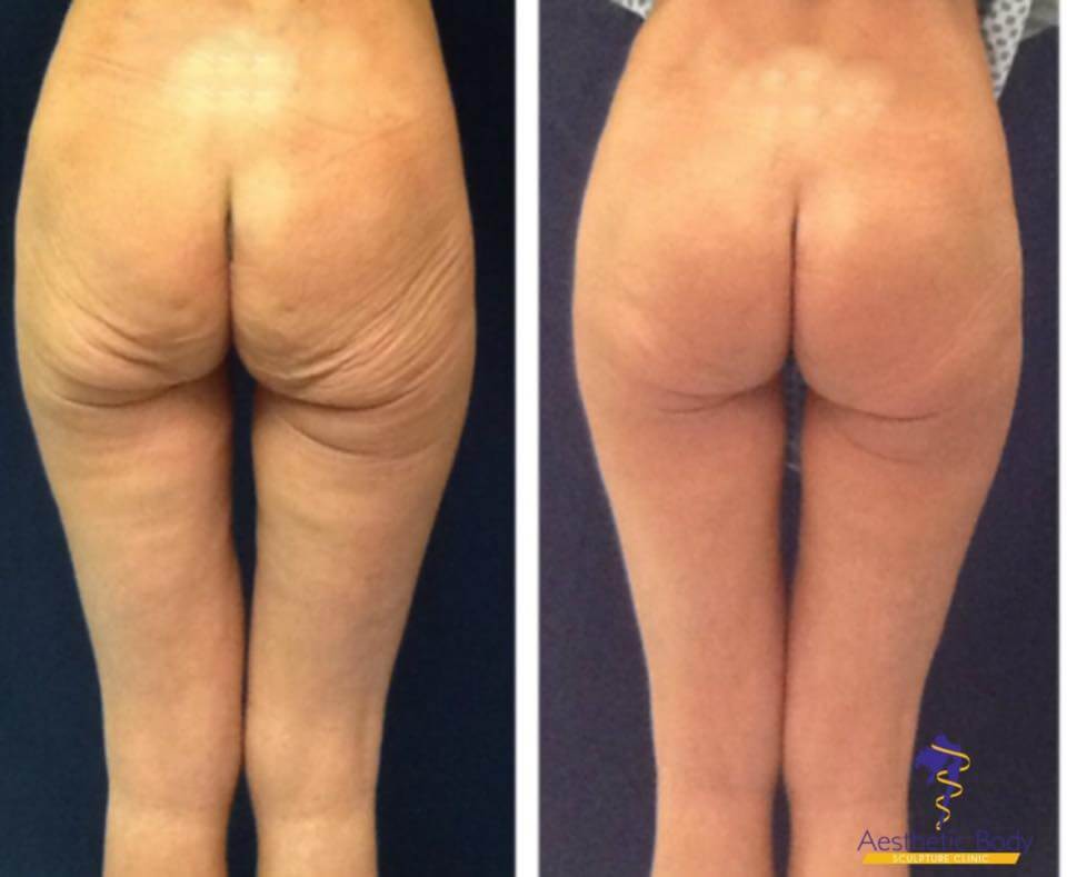 Sculptra Injectable is a safe method to achieve a rounder fuller Butt. Sculptra Butt Lift Before and After slateraesthetics.com