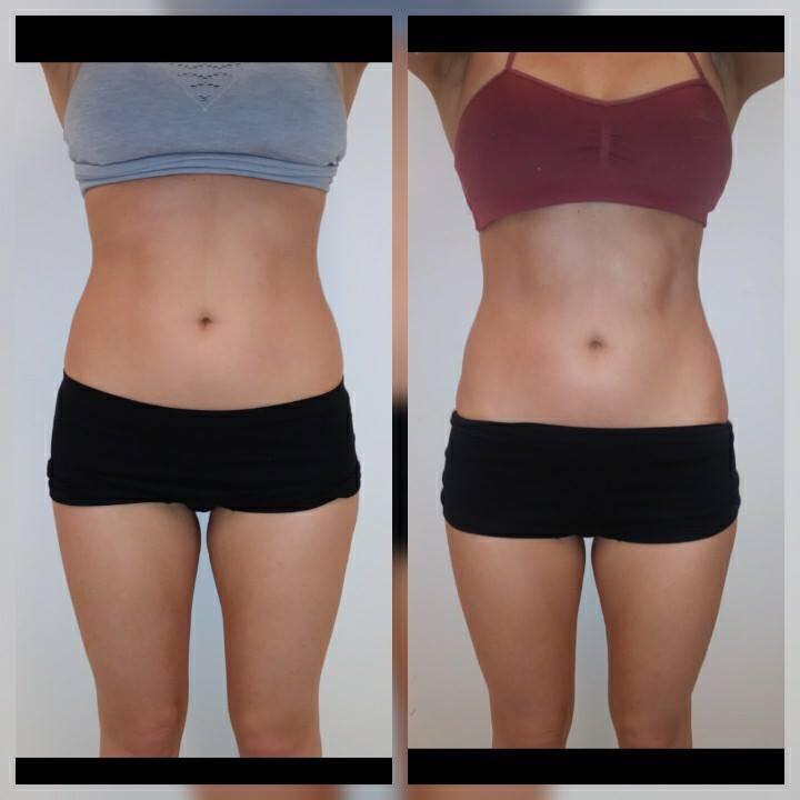 Before & After 2 Body Sculpting Sessions 