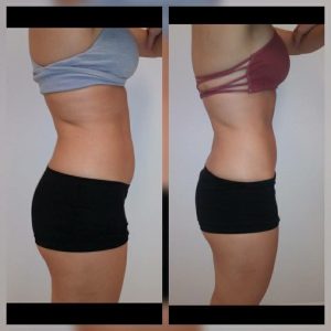 Before and after 2 Posh Body Slim Body Contouring Sessions – Treatment Goal Fat Reduction & Skin Tightening