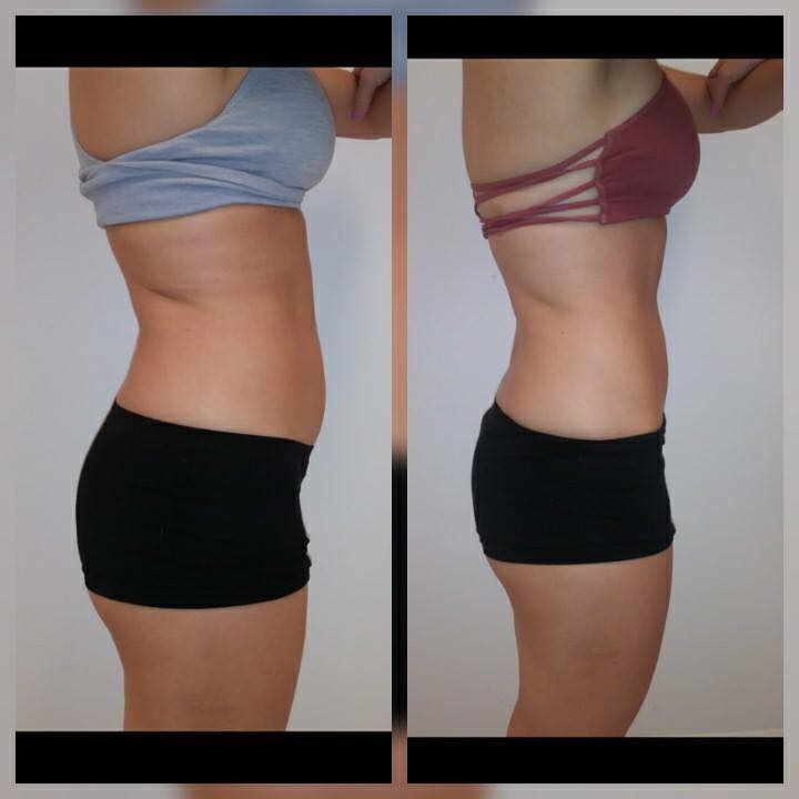 Before & After Body Sculpting Sessions for Fat Reduction and Skin Tightening