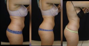 30-year old Before and after 3 Posh Body Slim Body Contouring Sessions – Treatment Goal Fat Reduction & Skin Tightening