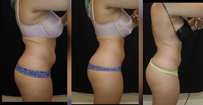 before and after 2-body sculpting-treatments Treatment-goal-fat-reduction-skin-tightening
