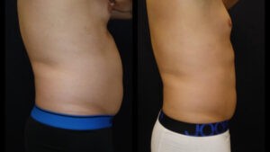 Before and after 2 Posh Body Slim Body Contouring Sessions – Treatment Goal Fat Reduction