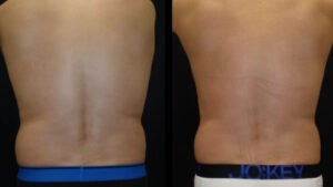 Before and after 2 Posh Body Slim Body Contouring Sessions – Treatment Goal Fat Reduction