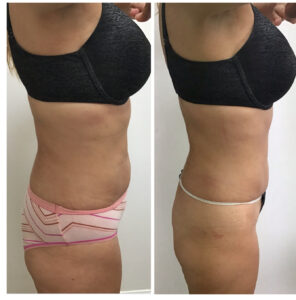 Get Results with the Posh Body Slim Body Sculpting System Before and after 1 Posh Body Slim Body Contouring Session – Treatment Goal Fat Reduction & Skin Tightening