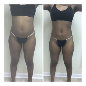 Get Results with the Posh Body Slim Body Sculpting System. Before and after 1 Posh Body Slim Body Contouring Session – Treatment Goal Fat Reduction & Skin Tightening