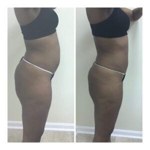 Get Results with the Posh Body Slim Body Sculpting System. Before and after 1 Posh Body Slim Body Contouring Session – Treatment Goal Fat Reduction & Skin Tightening