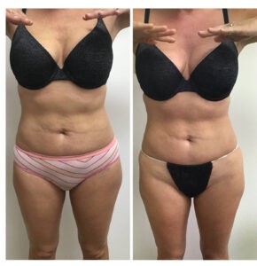 Get Results with the Posh Body Slim Body Sculpting System – Before and after 1 Posh Body Slim Body Contouring Session – Treatment Goal Fat Reduction & Skin Tightening