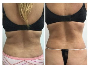 Before and after 1 Posh Body Slim Body Contouring Session – Treatment Goal Fat Reduction & Skin Tightening