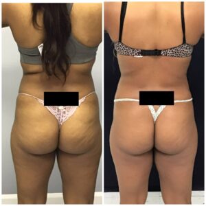 Before and after 4 Posh Body Slim Treatments for Fat Reduction and Skin Tightening. Experience Body Sculpting without Pain.