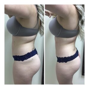 Before and after One Posh Body Slim Treatment for Fat Reduction, lifting and toning.