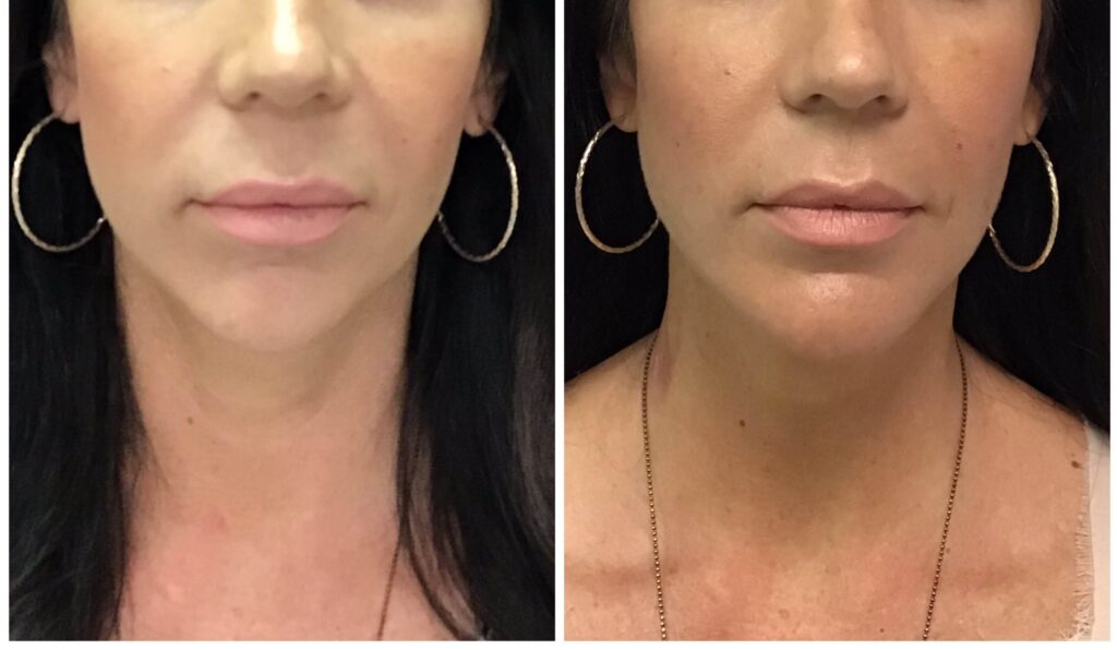 Before and after Y Lift by Dr. Monte Slater