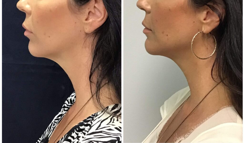 Before and after Y Lift by Dr. Monte Slater