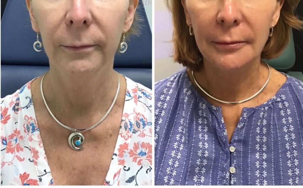 Before and after Y Lift by Dr. Monte Slater