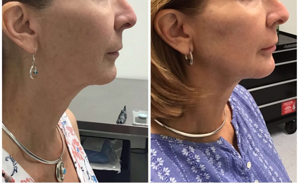 Before and after Y Lift by Dr. Monte Slater
