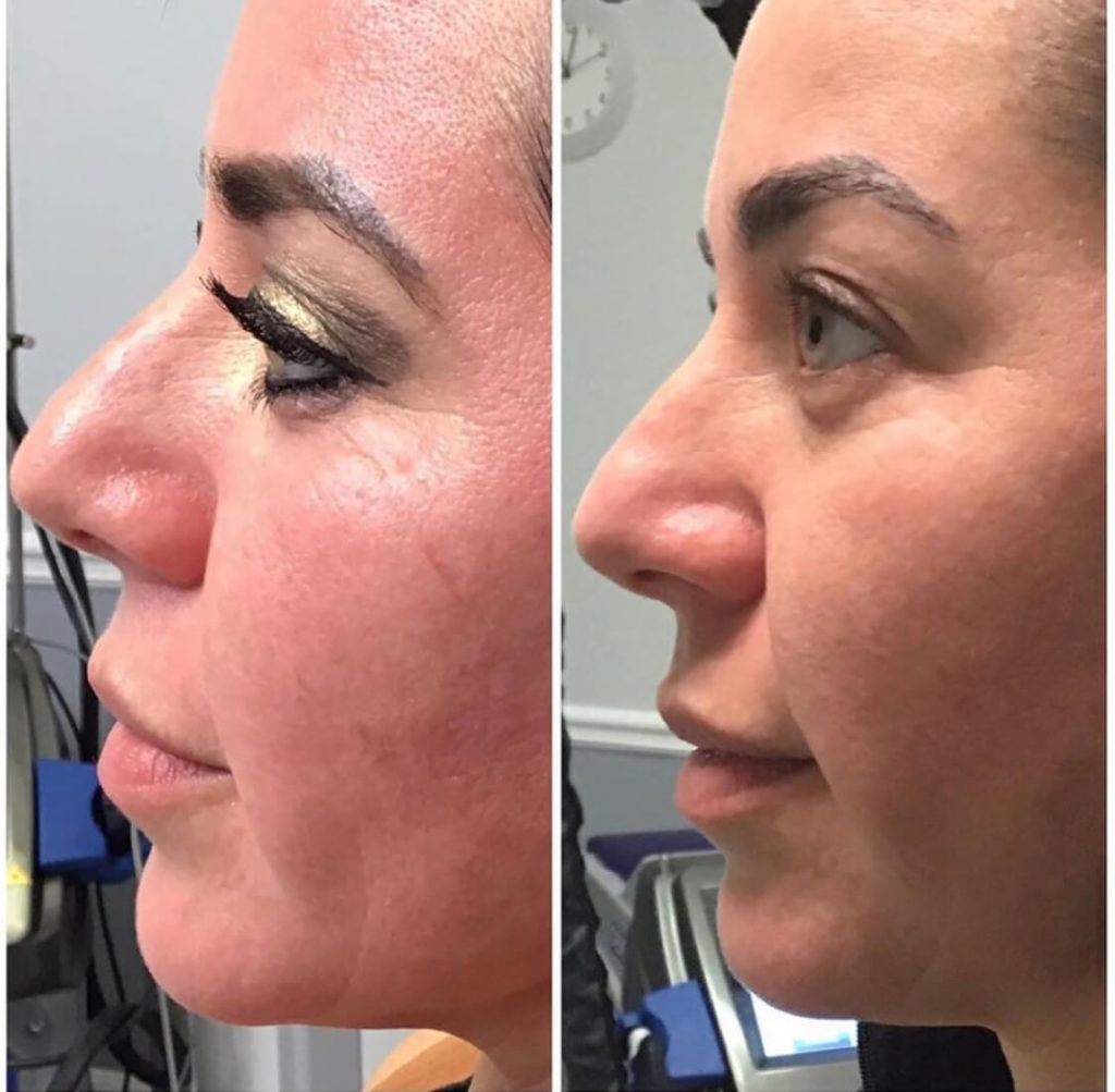 Before and Three Weeks After Receiving the CoolPeel Laser Treatment with Dr. Monte Slater 