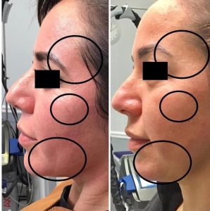 Before and Three Weeks After Receiving the CoolPeel Laser Treatment with Dr. Monte Slater