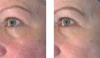 Patient Before and After the Vivace Treatment