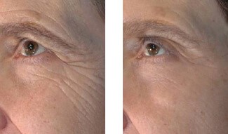 Patient Before and After the Vivace Treatment offered at Aesthetic Body Sculpture Clinic in Atlanta and Warner Robins