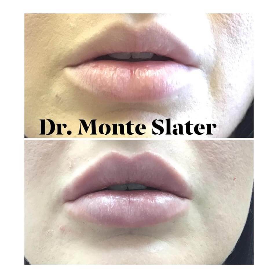 Patient Before and After Kysse Lip fil.er Aesthetic Body Sculpture Clinic in Atlanta and Warner Robins