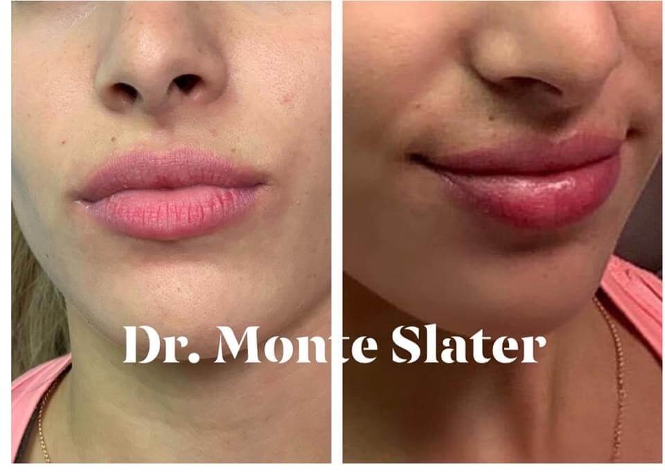 Before and After Kysse Lip fil.er with Dr. Monte Slater in Atlanta Georgia 