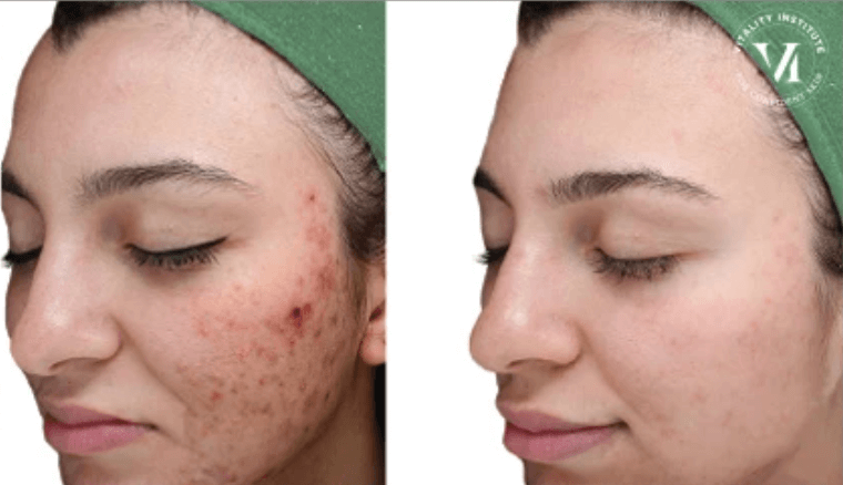 Chemical Peel for Skin Rejuvenation offered by Dr. Monte Slater