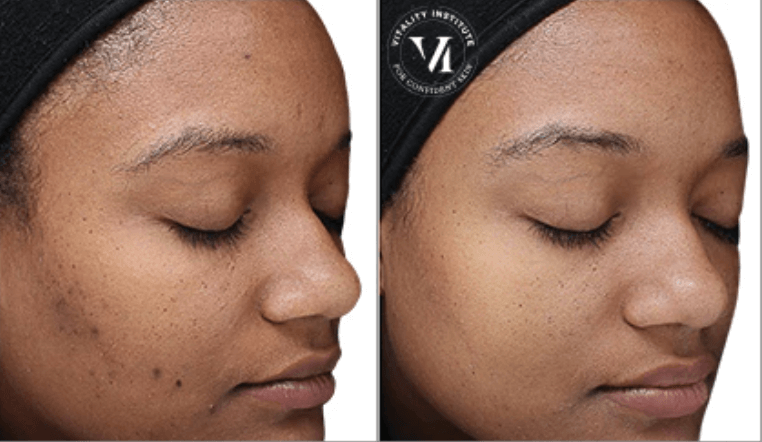 Chemical Peel for Skin Rejuvenation offered by Dr. Monte Slater