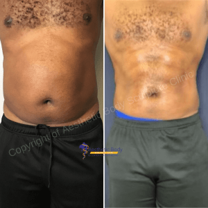 Dr. Slater"s Patient Before and After 5 PHYSIQ Treatments