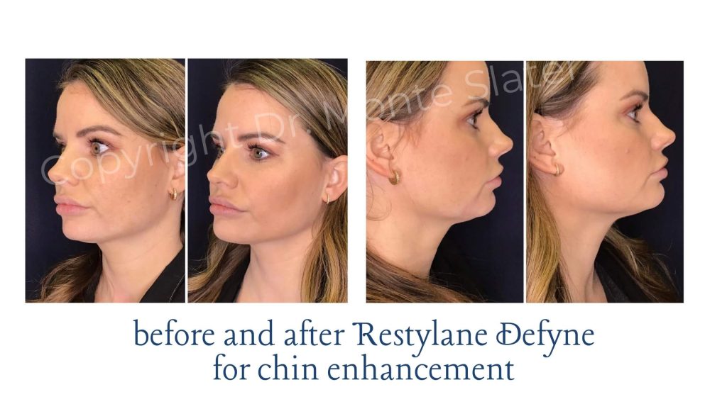 Before and After Restylane Defyne for Chin Enhancement