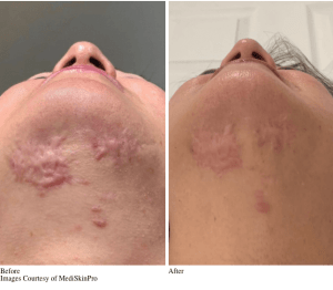 Before and After VirtueRf Microneedling Treatment for Skin Rejuvenation & Skin Tightening