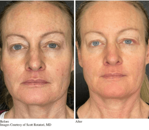 Before and After VirtueRf Microneedling Treatment for Skin Rejuvenation & Skin Tightening