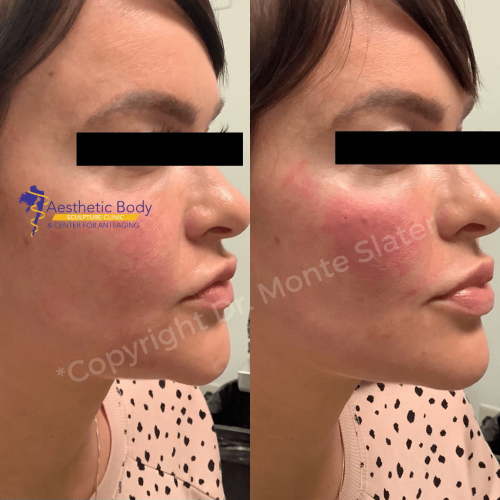 Before and after only one Syringe of Restylane Contour to the cheeks