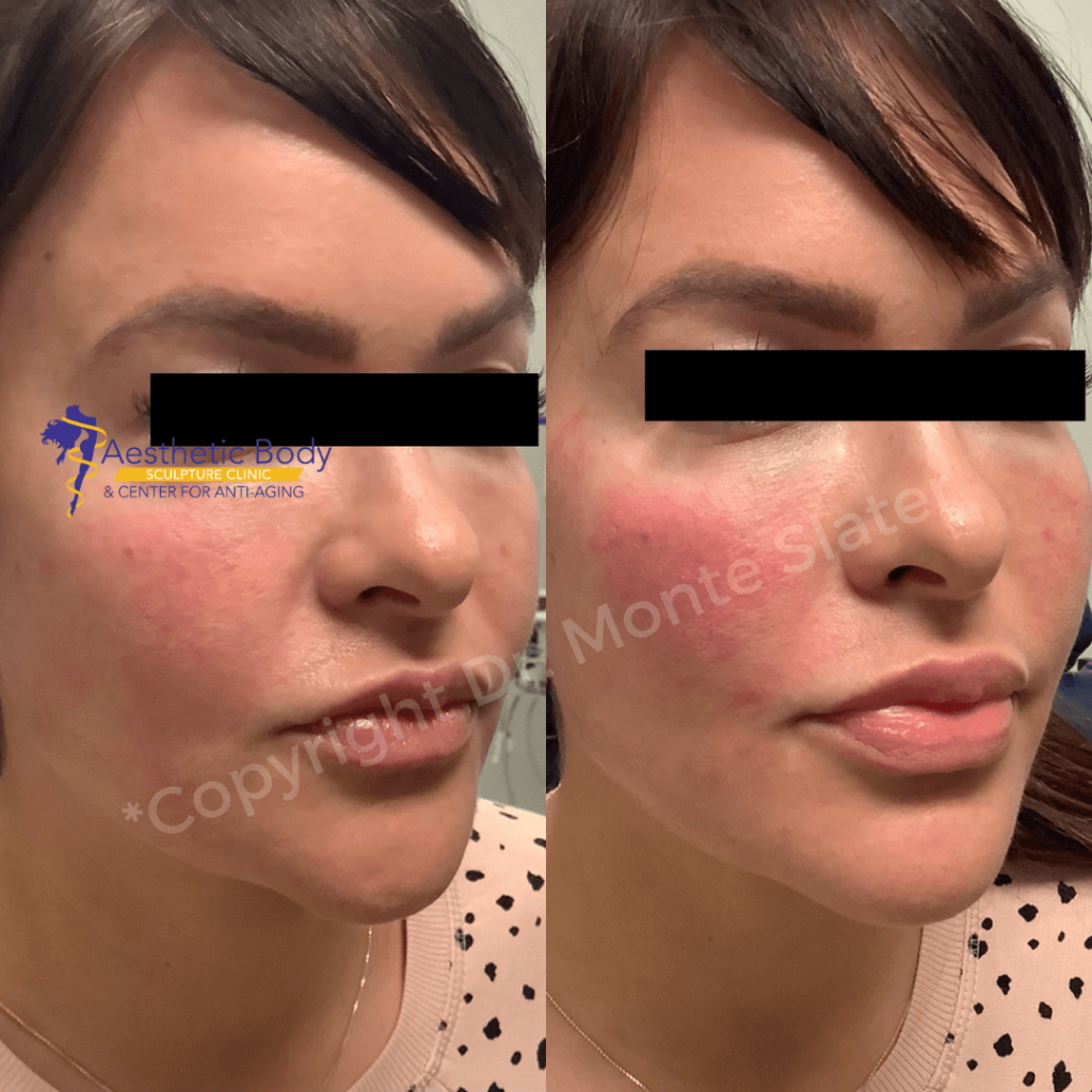 Before and after only one Syringe of Restylane Contour to the cheeks