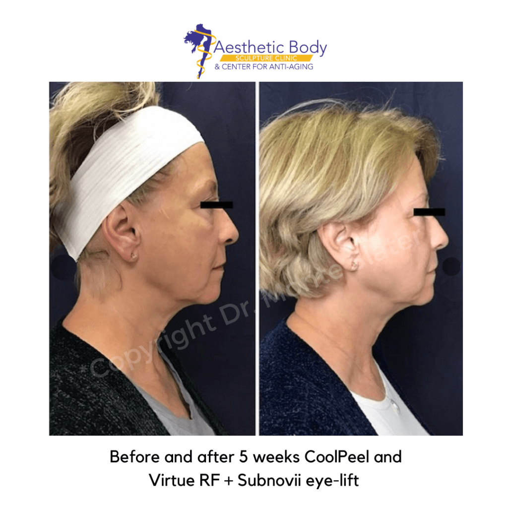 Before and after 5 weeks CoolPeel and Virtue RF + Subnovii eye-lift -Slater Aesthetic Body Sculpture Clinic Before and Afters