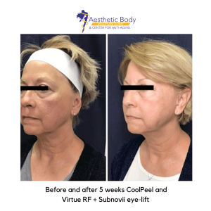 Before and after 5 weeks CoolPeel and Virtue RF + Subnovii eye-lift - Slater Aesthetic Body Sculpture Clinic Before and Afters