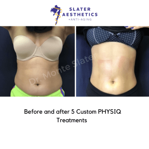 Before and after PHYSIQ front view 5 treatments