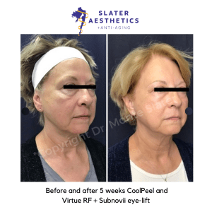Before and after 5 weeks of receiving CoolPeel Laser + Virtue RF Microneedling combination treatment for skin tightening and skin resurfacing by Dr. Monte Slater