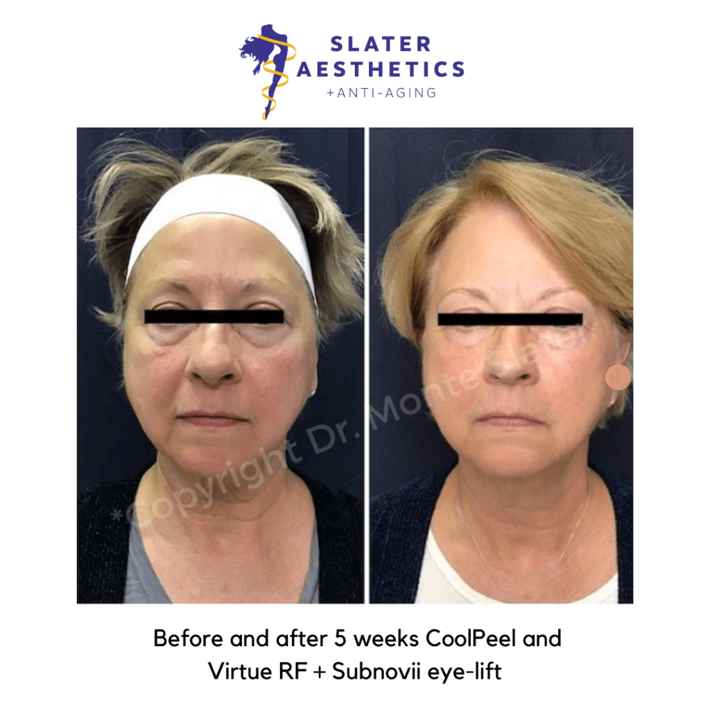 Before and after 5 weeks of receiving CoolPeel Laser + Virtue RF Microneedling + Subnovii Eye lift combination treatment for skin tightening and skin resurfacing by Dr. Monte Slater