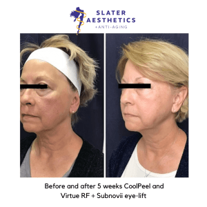 Before and after 5 weeks of receiving CoolPeel Laser + Virtue RF Microneedling + Subnovii Eye lift combination treatment for skin tightening and skin resurfacing by Dr. Monte Slater