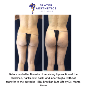 Before and after 8 Weeks of receiving liposuction with fat transfer to the buttocks - BBL by Dr. Monte Slater