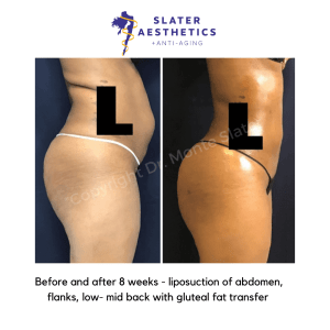 Before and after 8 weeks of liposuction of abdomen, flanks, low-mid-back with fat transfer to the buttocks - BBL - Brazilian Butt Lift by Dr. Monte Slater