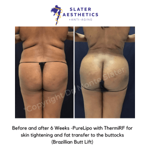 Before and after 6 weeks of PureLipo with ThermiRF for skin tightening and fat transfer to buttocks -BBL - Brazilian Butt Lift by Dr. Monte Slater