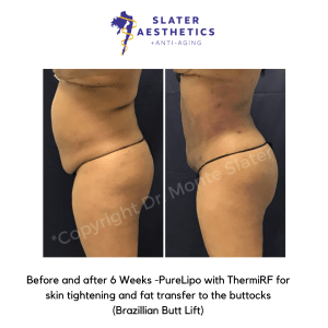 Before and after 6 weeks of Liposuction of abs, flanks, low-back, mid-back with ThermiTight for skin tightening and fat transfer to buttocks -BBL - Brazilian Butt Lift by Dr. Monte Slater