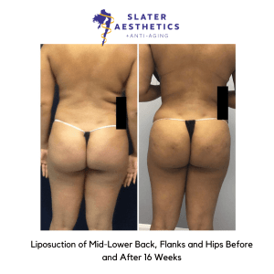 Before and after 16 Weeks liposuction of mid lower back Flanks and Hips