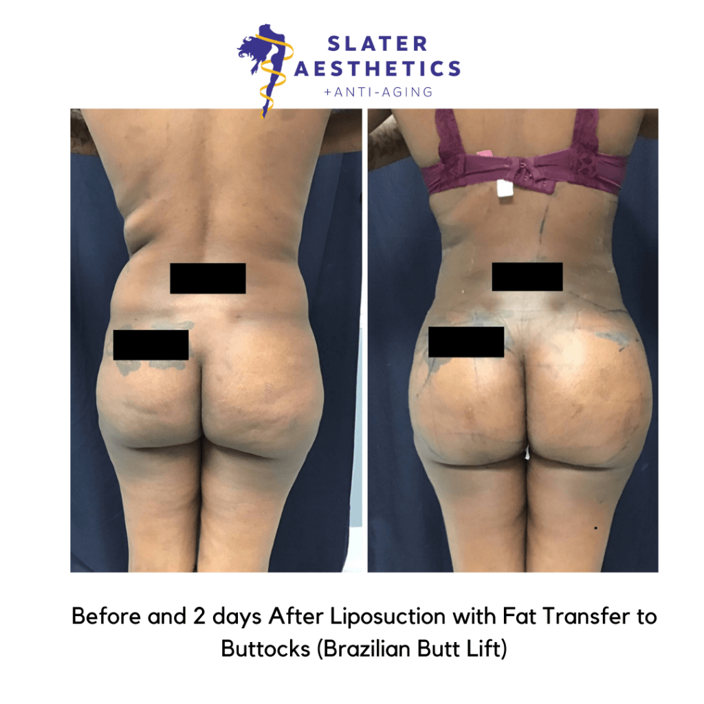 Brazilian Butt Lift  Lipoaesthetic Female
